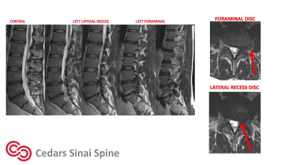 Surgical Case Video: Tubular Decompression Surgery