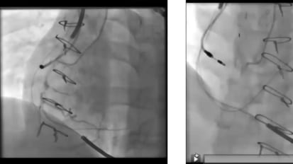 Coronary Revascularization in Systolic Heart Failure