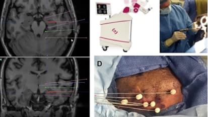 Drug-resistant Epilepsy - Interventions beyond Pharmacotherapy