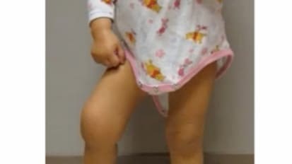 The Swollen Knee and JIA