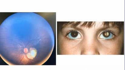 Retinoblastoma: Presentation and Management