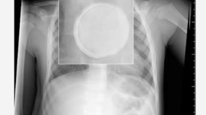 Management of Ingested Foreign Bodies