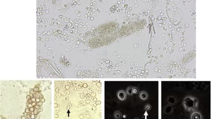 Hematuria