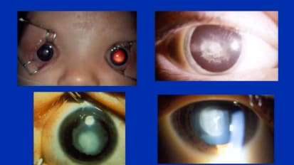 Common Pediatric Eye Problems: When to Hold'em and When To Fold'em