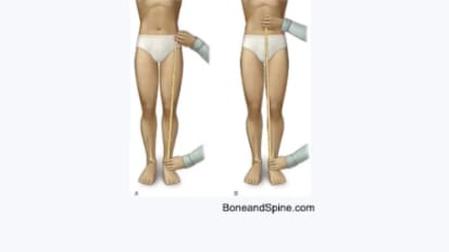 The Child With A Limp: When To Call Rheumatology