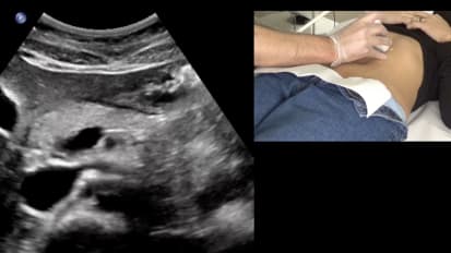 Duplex Ultrasound: Evaluation for Obstruction. A Case of Positional Iliac Vein Compression