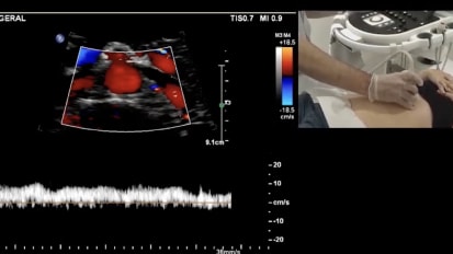 Duplex Ultrasound: Pelvic Reflux