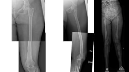 Femoral Lengthening With Deformity Correction