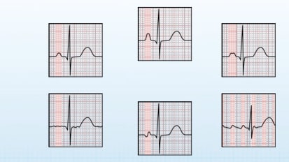 EKG Review