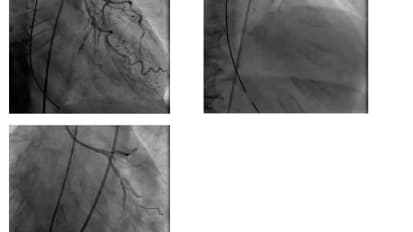 Treatment of STEMI