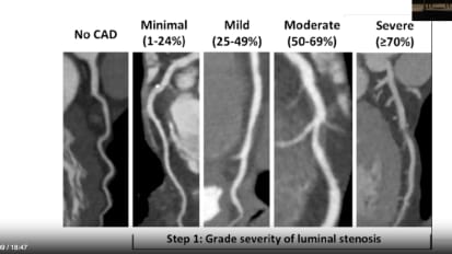 Coronary CT Anatomy & Plaque Morphology