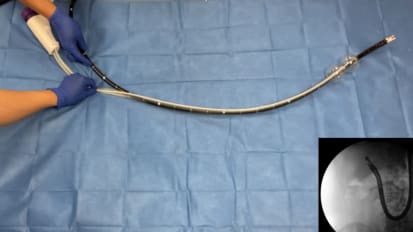 Innovative Use of Colonic Balloon Overtube with EUS Scopes