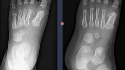 Common Pediatric Orthopedic Injuries: Management for the PCP
