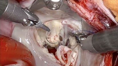 A Patient-Centered Approach to Mitral Valve Surgery –From Sternotomy to Robotics and Beyond