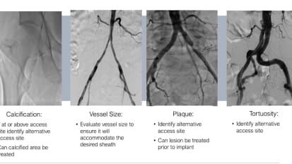 Access and Groin Management: The Use of Ultrasound for Vascular Access
