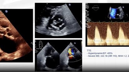 Structural Heart Case: Mitral