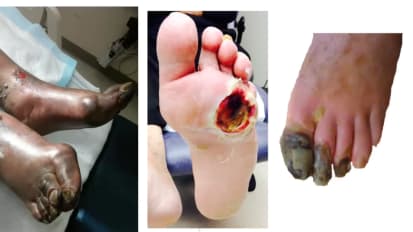 Vascular Surgery and Non-Healing Peripheral Wounds