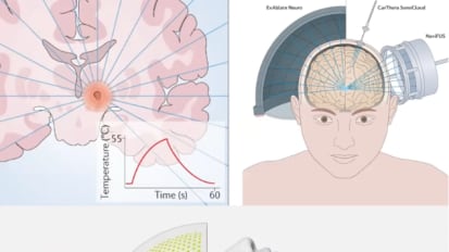 Application of Focused Ultrasound in Essential Tremor and other Movement Disorders