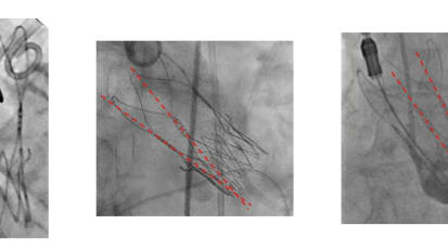 Trial Highlights from TCT 2024
