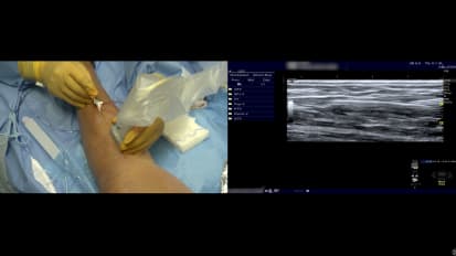 Left GSV Ablation with Venclose™ RF Ablation Catheter