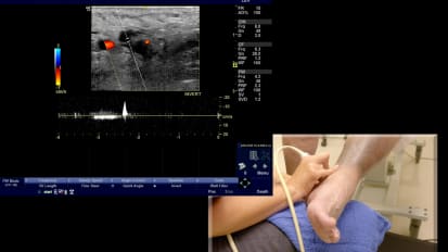 Duplex Ultrasound Examination: Perforators with Lipodermatosclerosis