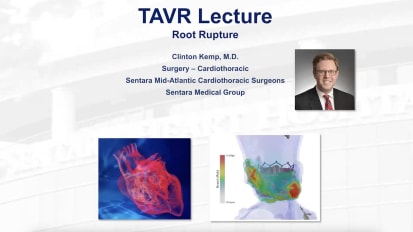 Root Rupture
