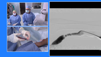 Angioplasty of a Transposed Basilic Vein A/V Fistula