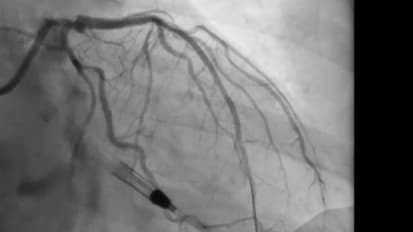 Use of MCS for High Risk PCI 