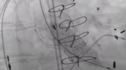 Lifetime Management of Aortic Stenosis