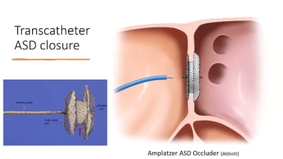 The Effect of Intra- and Extra-Cardiac Shunts on Pulmonary Vascular Disease in sBPD
