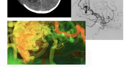 Costs and Complications of Pediatric Stroke: Why Early Identification and Intervention Are Priceless