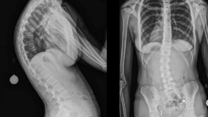 Curves of the Pediatric Back: Kyphosis and Scoliosis