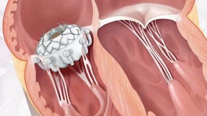 Optimizing Heart Failure Treatment: The Synergy of Device Therapies and Contemporary GDMT
