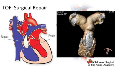 Tetralogy of Fallot in 2025: A Review and What's New Interventionally and Electrically