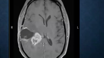 Targeted therapies and immune-based strategies are creating new hope in neuro-oncology