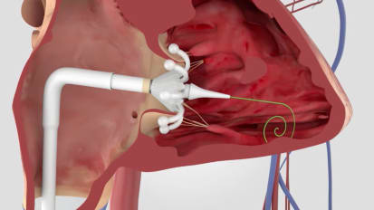 New technologies used for tricuspid valve repair or replacement