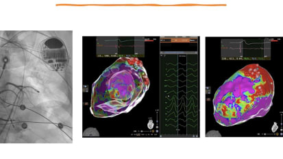 Updates from Heart Rhythm Society 2025