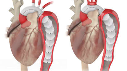 New Developments in the Endovascular Treatment for Ascending and Arch Segment
