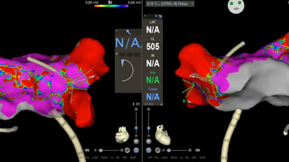 Atrial Fibrillation: Modern Day Treatment