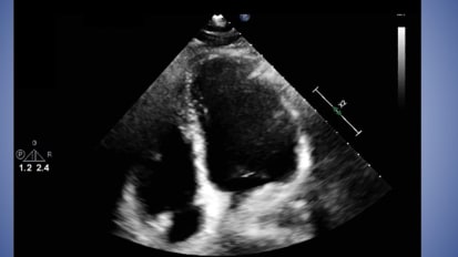 Comparison of Chagas and Sarcoid Cardiomyopathy