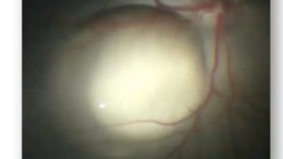 Gene therapy for inherited retinal diseases