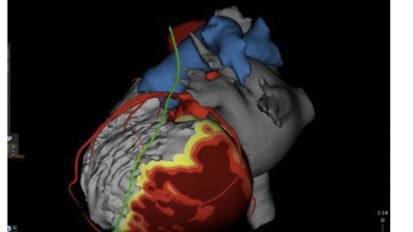 Beyond ICD Shocks and Drugs: Modern Approaches to Ventricular Tachycardia Ablation 