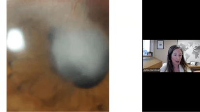 Corneal Blindness in SSA: Diagnostics, Treatments, and Innovations