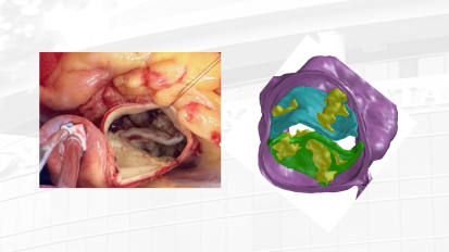  TAVR “vs” SAVR In The Modern Era