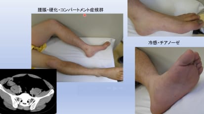 Comprehensive Overview of Deep Vein Thrombosis