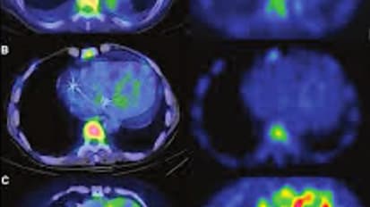 TTR Amyloidosis: An Underrecognized Disease