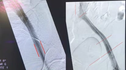 Lecture Video: Optimal Approch to Venous Stenting (July 18, 2025)