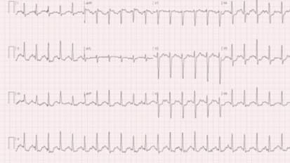 Non-Invasive Testing for Coronary Artery Disease