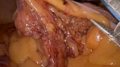 A closer look at robotic surgery for colorectal cancer