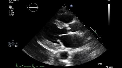 Aortic Stenosis